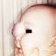 22. Cavernous Hemangioma in Newborns Pictures
