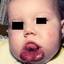 23. Cavernous Hemangioma in Newborns Pictures