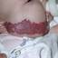 3. Cavernous Hemangioma in Newborns Pictures