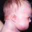 4. Cavernous Hemangioma in Newborns Pictures