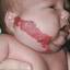 5. Cavernous Hemangioma in Newborns Pictures