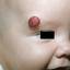 6. Cavernous Hemangioma in Newborns Pictures