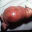 9. Cavernous Hemangioma in Newborns Pictures