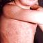 7. German Measles in Adults Pictures