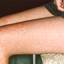 10. Rubella in Adults Pictures