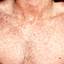 9. Rubella in Adults Pictures