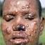 1. Leprosy Pictures