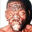 14. Leprosy Pictures