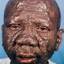 16. Leprosy Pictures