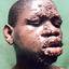 4. Leprosy Pictures