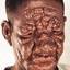 5. Leprosy Pictures