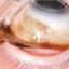 1. Ocular Melanoma Pictures