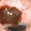 10. Ocular Melanoma Pictures
