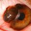11. Ocular Melanoma Pictures