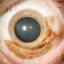 12. Ocular Melanoma Pictures