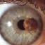 15. Ocular Melanoma Pictures