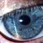 17. Ocular Melanoma Pictures
