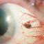 19. Ocular Melanoma Pictures