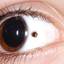 2. Ocular Melanoma Pictures