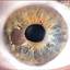 20. Ocular Melanoma Pictures
