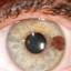 21. Ocular Melanoma Pictures