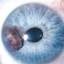 23. Ocular Melanoma Pictures