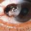 26. Ocular Melanoma Pictures