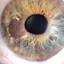 3. Ocular Melanoma Pictures