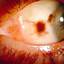 4. Ocular Melanoma Pictures