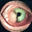 6. Ocular Melanoma Pictures