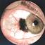 7. Ocular Melanoma Pictures