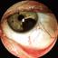 8. Ocular Melanoma Pictures