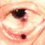 9. Ocular Melanoma Pictures