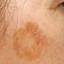 10. Melanoma on Face Pictures