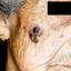 11. Melanoma on Face Pictures