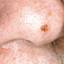13. Melanoma on Face Pictures