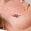 16. Melanoma on Face Pictures