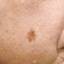 18. Melanoma on Face Pictures