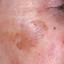 2. Melanoma on Face Pictures