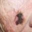 20. Melanoma on Face Pictures