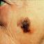 22. Melanoma on Face Pictures