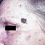 3. Melanoma on Face Pictures