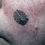 5. Melanoma on Face Pictures