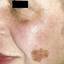 6. Melanoma on Face Pictures