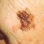 9. Melanoma on Face Pictures