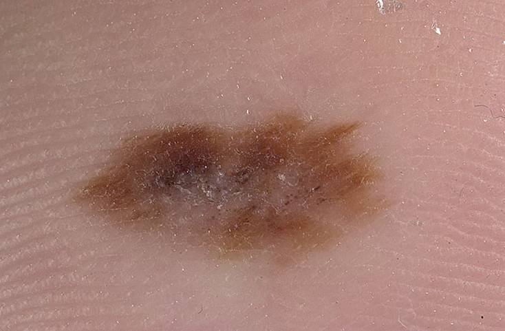 Melanoma On Leg Pictures 16 Photos Images Illnessee