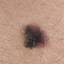 1. Stage 1 Melanoma Pictures