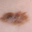 15. Stage 1 Melanoma Pictures