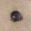 18. Stage 1 Melanoma Pictures