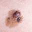 22. Stage 1 Melanoma Pictures